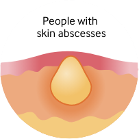 Skin abscess